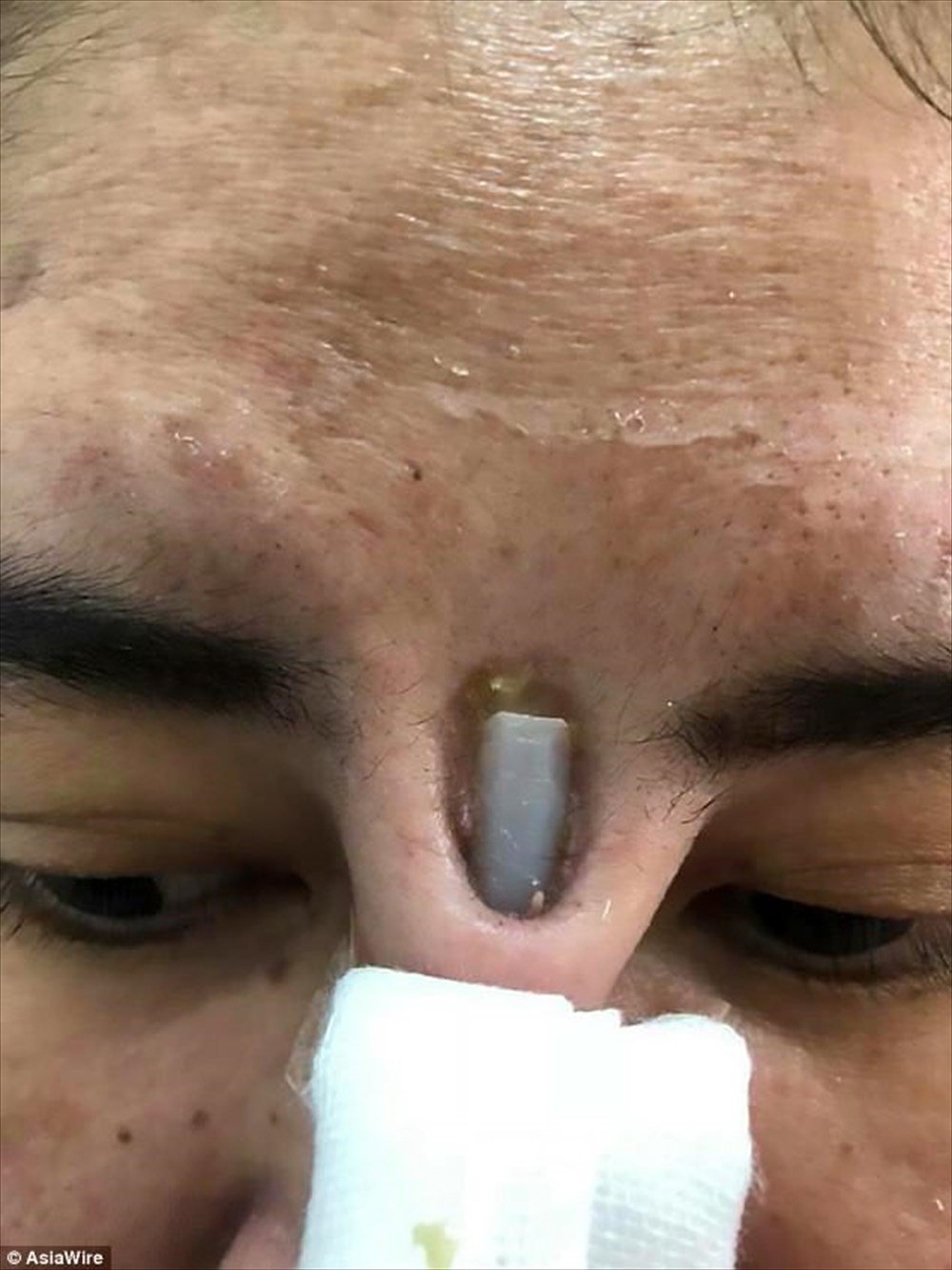 エニグム 鼻を高くするために美容整形を受けた女性の体に異変が起きた 術後しばらくして 眉間からシリコン製のインプラントが出てきたのだ クリニックは知らんぷり 美容整形で鼻に埋めたインプラントが飛び出てきた女性 T Co Akujt96n0i