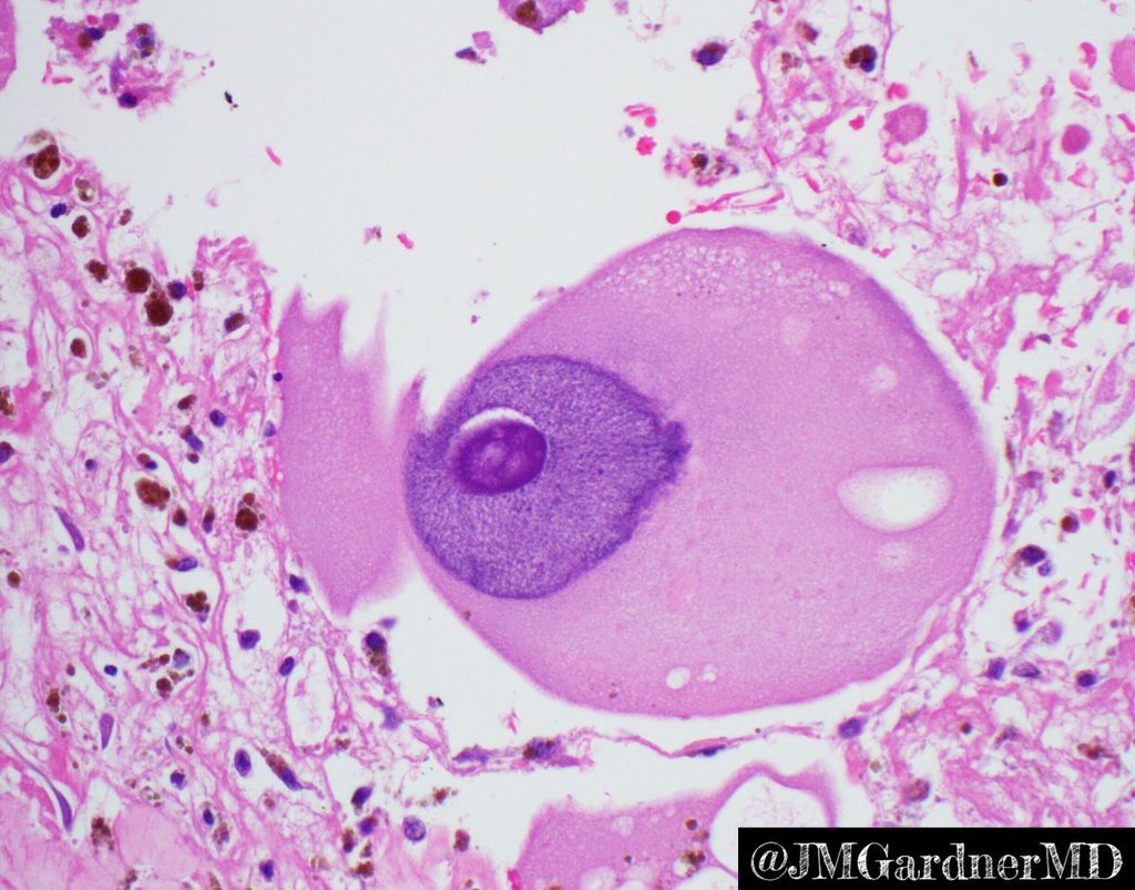 JMGardnerMD's tweet photo. Extreme bizarre pleomorphism in an undifferentiated pleomorphic #sarcoma. Useful definition of  pleomorphism = variation in size of at least 3x between smallest &amp; largest tumor nucleus. These massive nuclei could have eaten 100 other tumor cells for breakfast! #pathology #BSTpath https://t.co/nSCTYCW7GH