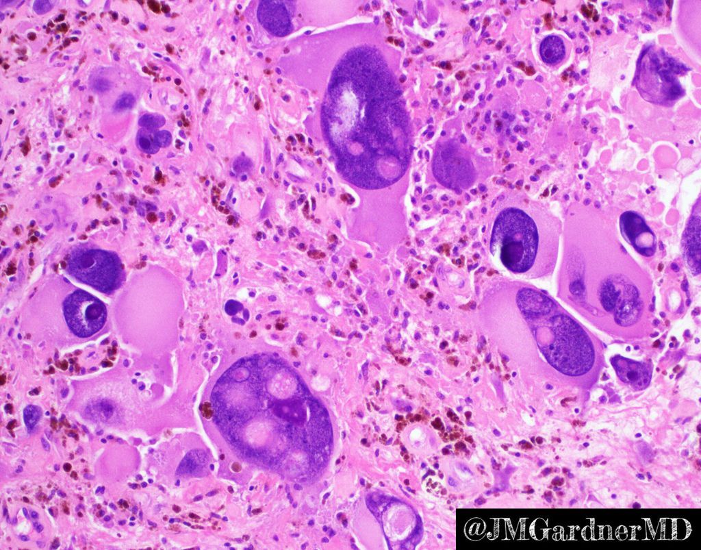 JMGardnerMD's tweet photo. Extreme bizarre pleomorphism in an undifferentiated pleomorphic #sarcoma. Useful definition of  pleomorphism = variation in size of at least 3x between smallest &amp; largest tumor nucleus. These massive nuclei could have eaten 100 other tumor cells for breakfast! #pathology #BSTpath https://t.co/nSCTYCW7GH