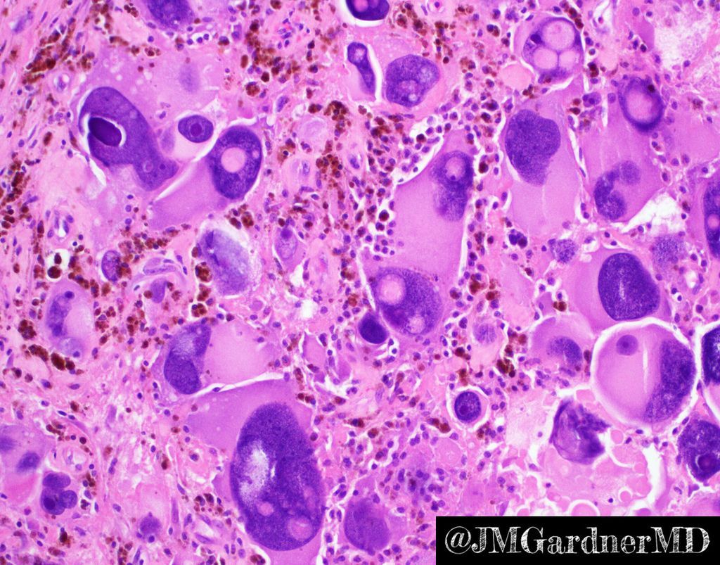 JMGardnerMD's tweet photo. Extreme bizarre pleomorphism in an undifferentiated pleomorphic #sarcoma. Useful definition of  pleomorphism = variation in size of at least 3x between smallest &amp; largest tumor nucleus. These massive nuclei could have eaten 100 other tumor cells for breakfast! #pathology #BSTpath https://t.co/nSCTYCW7GH