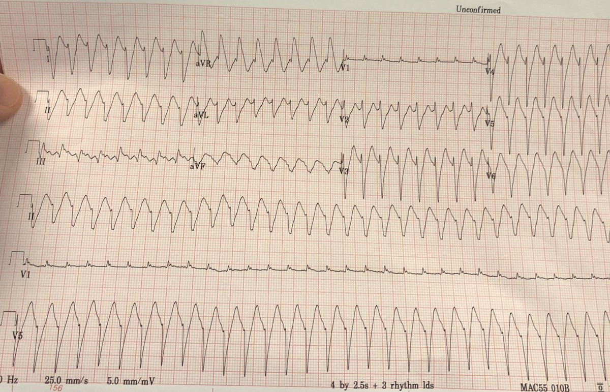 lee_gemma_MD's tweet photo. SVT vs VT debate today in the ED. “Northwest axis points toward heaven and is VT 100% of the time.” - Marc Josephson https://t.co/ESYhLwf4ur