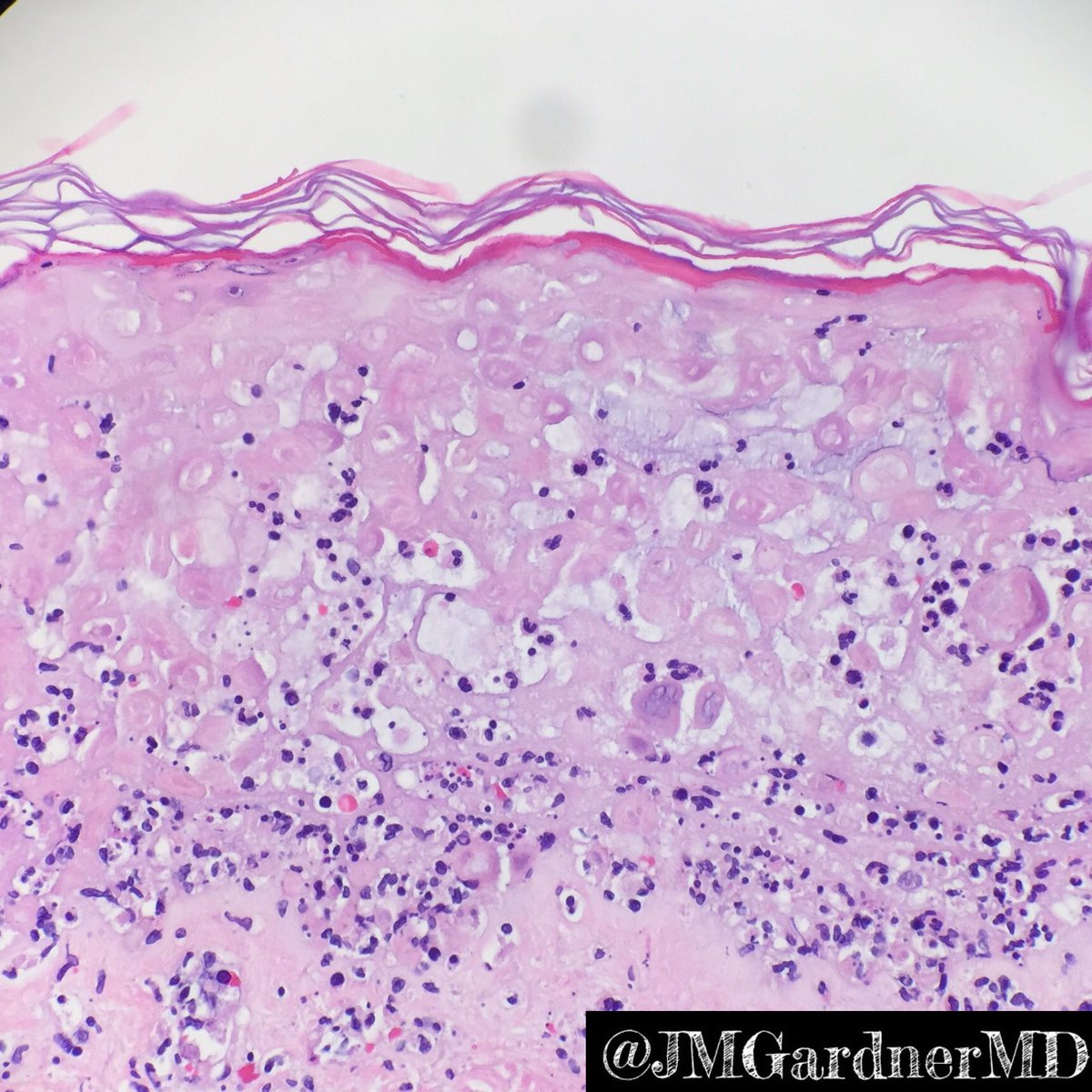 JMGardnerMD's tweet photo. Sneaky case of Herpes! “Dirty” epidermal necrosis with neutrophils &amp; debris. Lichenoid infiltrate. DEEP perivascular lymphocytic inflammation. Viral cytopathic effect may be focal or absent. In doubt? Do deeper levels &amp; IHC #mysterydiagnosis #mysterydxmondays #sanjayed #pathology https://t.co/e72HfOLU18