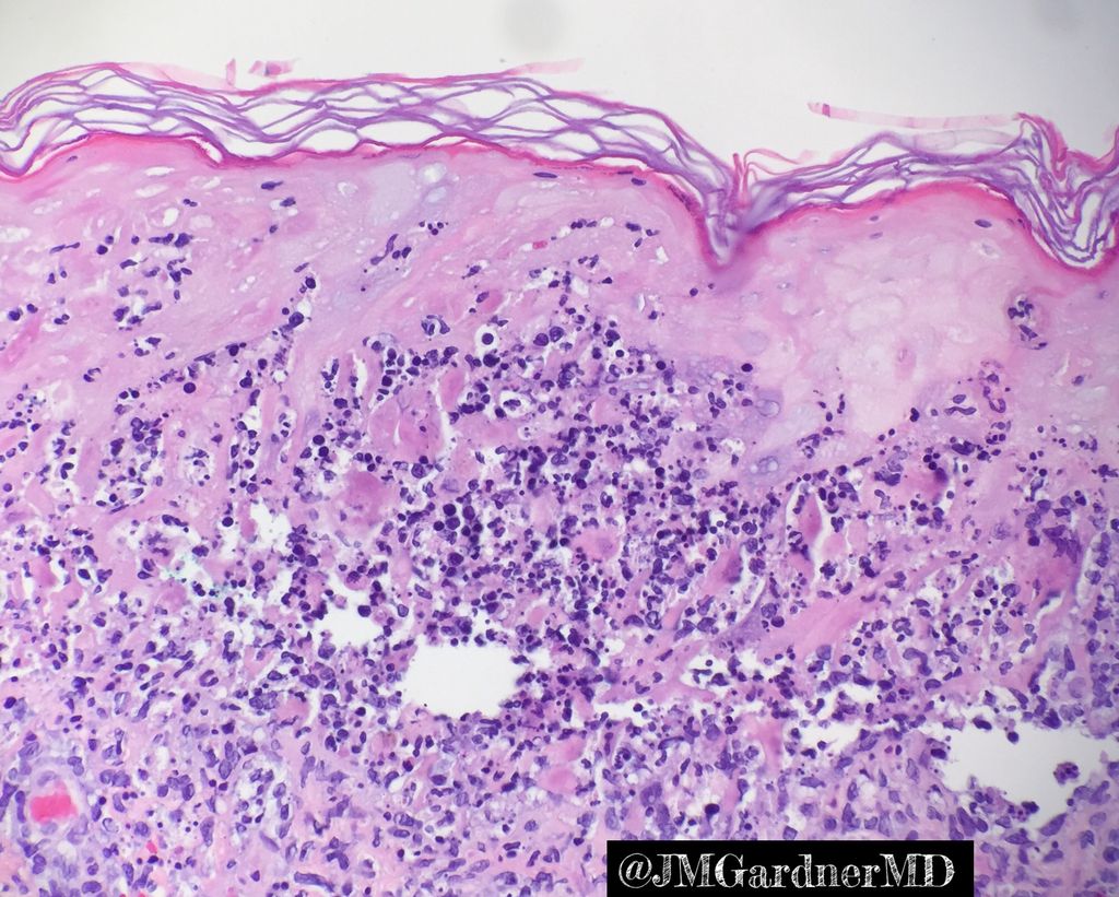 JMGardnerMD's tweet photo. Sneaky case of Herpes! “Dirty” epidermal necrosis with neutrophils &amp; debris. Lichenoid infiltrate. DEEP perivascular lymphocytic inflammation. Viral cytopathic effect may be focal or absent. In doubt? Do deeper levels &amp; IHC #mysterydiagnosis #mysterydxmondays #sanjayed #pathology https://t.co/e72HfOLU18