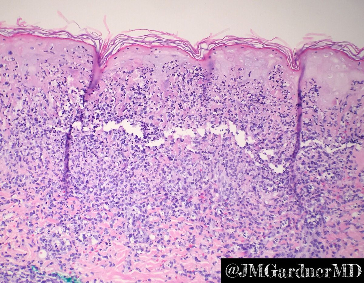 JMGardnerMD's tweet photo. Sneaky case of Herpes! “Dirty” epidermal necrosis with neutrophils &amp; debris. Lichenoid infiltrate. DEEP perivascular lymphocytic inflammation. Viral cytopathic effect may be focal or absent. In doubt? Do deeper levels &amp; IHC #mysterydiagnosis #mysterydxmondays #sanjayed #pathology https://t.co/e72HfOLU18