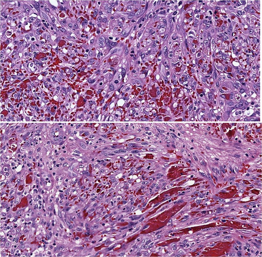 sortizreina's tweet photo. Dermal  spindle-shaped cells delimit like vascular spaces with red cell extravasation. Small hyaline globules PAS + are present. Nuclear immunostaining for  human herpesvirus type 8 (HHV-8) is detected.
Clinicopathological diagnostic: classic Kaposi sarcoma.
#dermpath #pathology https://t.co/rdym2OvY1M