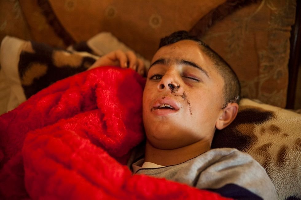 homebandon's tweet photo. "Mohammed Tamimi climbed up a wall...to check if there were still Israeli soldiers in the area. As soon as his head was above the wall, a soldier about five meters away shot him in the face with a rubber-coated steel bullet."   https://t.co/x9NaBjD6dW https://t.co/3y8MPwl7wD