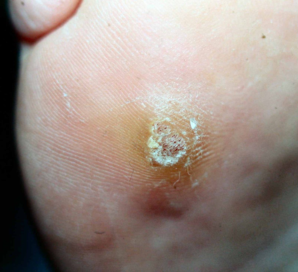 DrIvanBristow's tweet photo. Latest Blog: Around 7% of adults have warts, and about 41% of adults will have a wart at some stage in their life. Read more:  https://t.co/W3gN8F9URu #footexpert #podiatry https://t.co/FGZ6s2T5xV