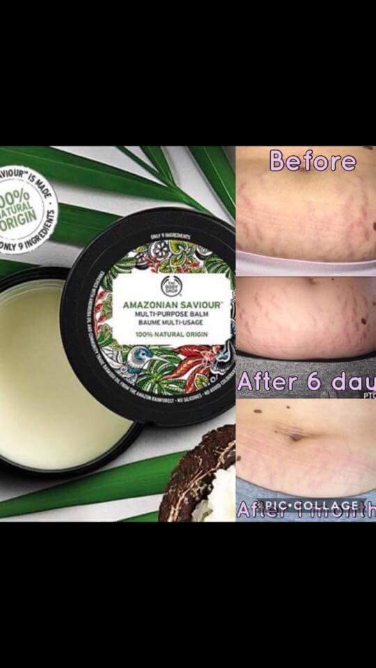 body shop stretch marks