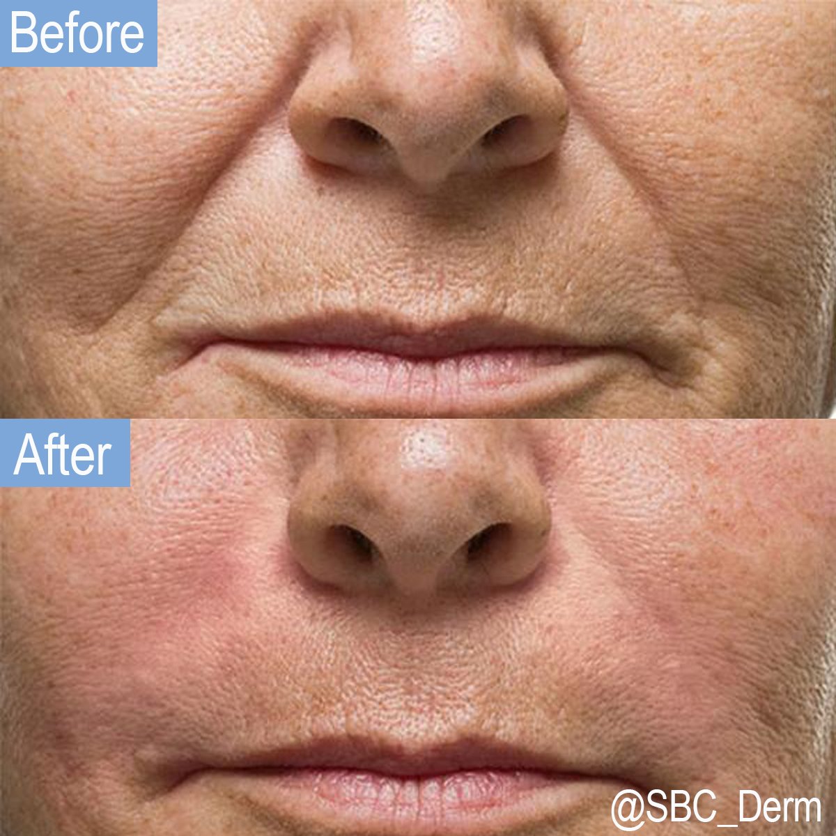 SBC_Derm's tweet photo. Check out our January Special! Be a new you this year with Radiesse fillers! 

#SBCDERM #fillers #burbank #specials https://t.co/LDisCwfjbK
