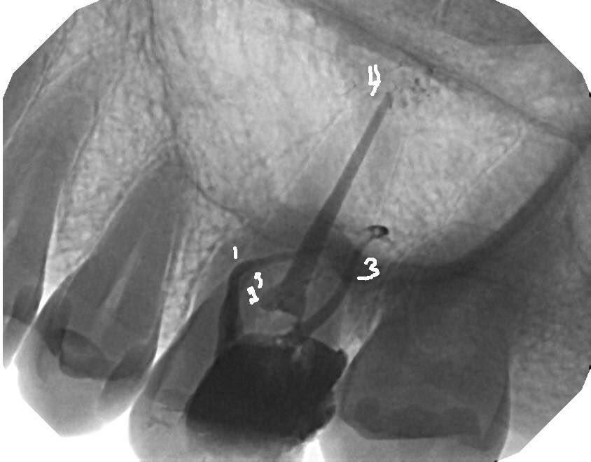 DrRicoShort's tweet photo. The SHORT Case Of The Day!
Tooth #14...Relax or Extract?
The decay is above the crest of bone so it's obviously restorable. RCT was completed in one visit using @EdgeEndo X7/04 & WVC with Kerr EWT sealer. There were 4 canals which is @90% on Mx 1st molars!
#RelaxDontExtract
๐ฏ https://t.co/orSKNOtJXN