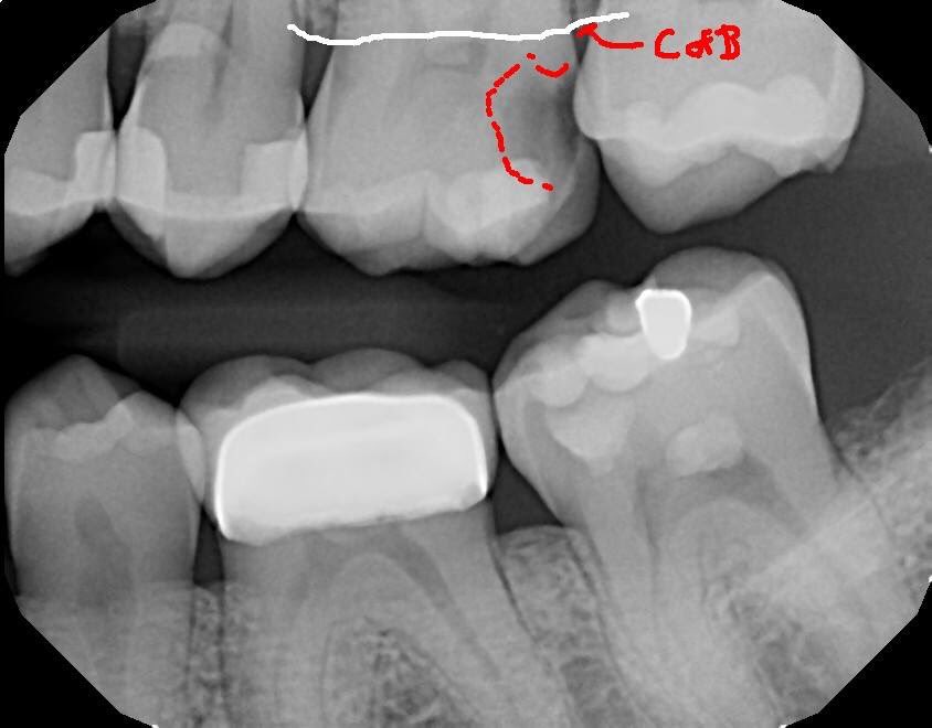 DrRicoShort's tweet photo. The SHORT Case Of The Day!
Tooth #14...Relax or Extract?
The decay is above the crest of bone so it's obviously restorable. RCT was completed in one visit using @EdgeEndo X7/04 & WVC with Kerr EWT sealer. There were 4 canals which is @90% on Mx 1st molars!
#RelaxDontExtract
๐ฏ https://t.co/orSKNOtJXN