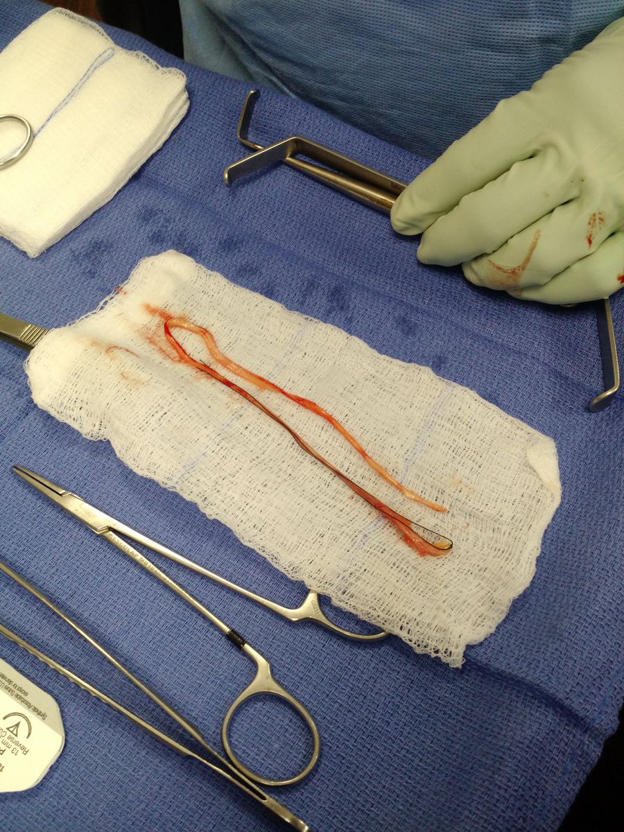 facialparalysis's tweet photo. Here is a behind the scenes look at how we harvest the #suralnerve from the lower leg during Stage 1 of a Cross Face Nerve Graft -1- These are the tools used for the harvest -2-
 Removing the nerve from the leg -3- The nerve completely removed from the leg #facialparalysis https://t.co/konWwI7Zlm