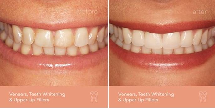 paramountsyd's tweet photo. Kick off the new year with a complimentary #smilemakeover consultation on us! Our patient has achieved the natural and beautiful smile she was searching for....https://t.co/reaw973AJs
#paramountlife #paramountdental #paramountservice #stjamestrust #keepsmiling #confidentsmile https://t.co/IOfsljLmQE
