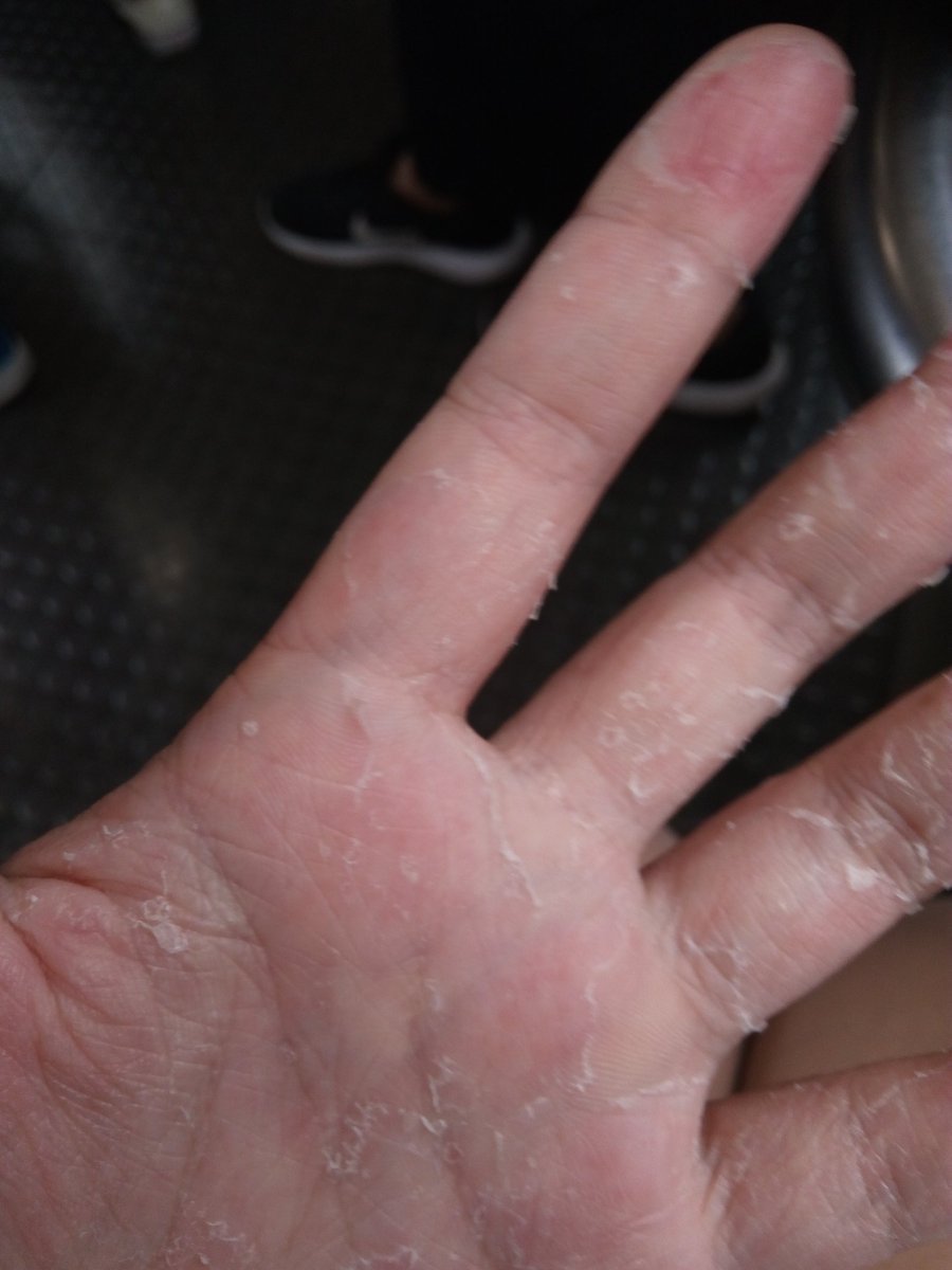 薛南 秋m3歌唱依頼してね 12 2kg V Twitter ちょっと質問がありますが 日本語では 冬になると 手の皮がボロボロ になっちゃう症状の名前は何ですか 手湿疹と違います Googleしても見つけられません 中国語では 富貴手 という 水仕事が出来なくて 昔のお 薛南 秋m3歌唱依頼してね 12 2kg V Twitter ちょっと質問がありますが 日本語では 冬になると 手の皮がボロボロ になっちゃう症状の名前は何ですか 手湿疹と違います Googleしても見つけられません 中国語では 富貴手 という 水仕事が出来なくて 昔のお