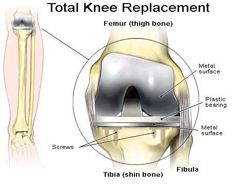 neiltheknee's tweet photo. RT @JournBoneres: #Kneereplacement #Femur #Tibia https://t.co/9PiQiqHUIQ