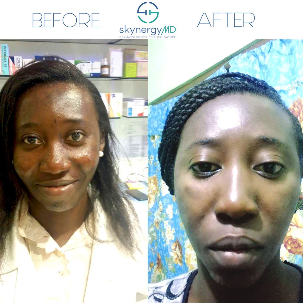 SkynergyMD's tweet photo. CLIENTS GETTING REAL RESULTS WITH SKYNERGYMD! We appreciate these actual client selfies showing the dramatic difference after just 3 weeks!! 🙌🙌🙌 💕💕 #skincarethread #tips #beauty #beautiful #skincareroutine #skincareobsessed #love #naturalbeauty #confidence #skin #skincare https://t.co/uWfD4VjVw9