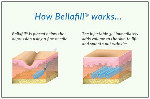 midwestaging's tweet image. Bellafill 💉 is unlike other fillers! It replaces collagen in the face and restructures the skin to create natural looking results. 💁‍♀️ Schedule an appointment with us soon and see results for yourself!
Call ☎️ us at: (815) 277-5229
