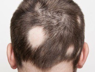 DFW Hair Loss (@DFWHairLoss) / Twitter DFW Hair Loss (@DFWHairLoss) / Twitter
