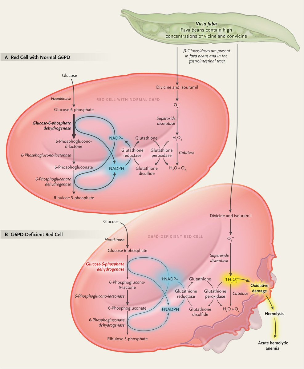 NEJM's tweet photo. Review Article: Favism and Glucose-6-Phosphate Dehydrogenase Deficiency https://t.co/pe5yb3NthT https://t.co/HDwCYgStVw