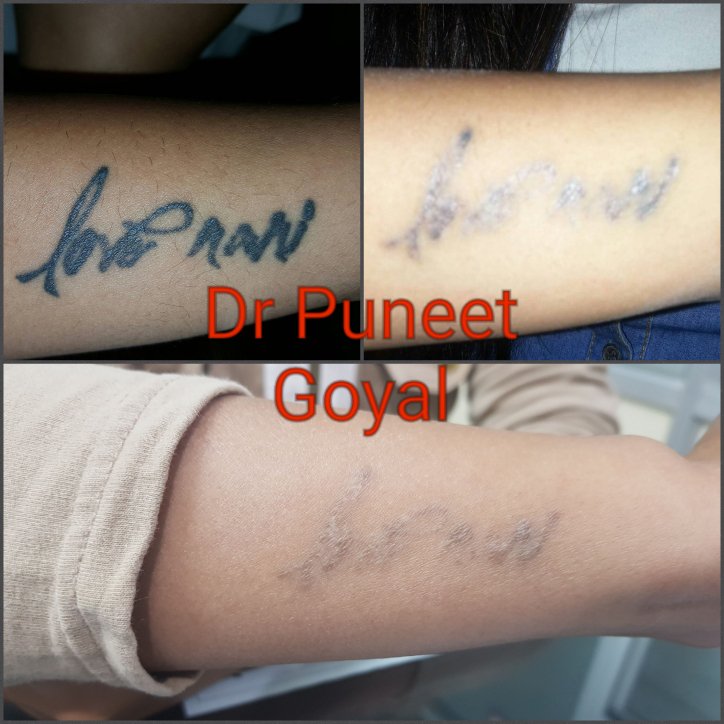 What You Need To Know About Tattoo Removal  Lazaderm Laser  Aesthetics