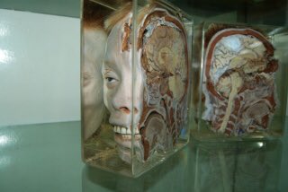 つばさ タイのシリラート博物館 別名死体博物館に行ってきました とにかく人間の死体の全体 または一部がホルマリン漬けで大量にある博物館 さらにくっついて生まれてきた奇形児 一部が肥大化した病例もホルマリン漬け あと死刑囚はミイラみたいな