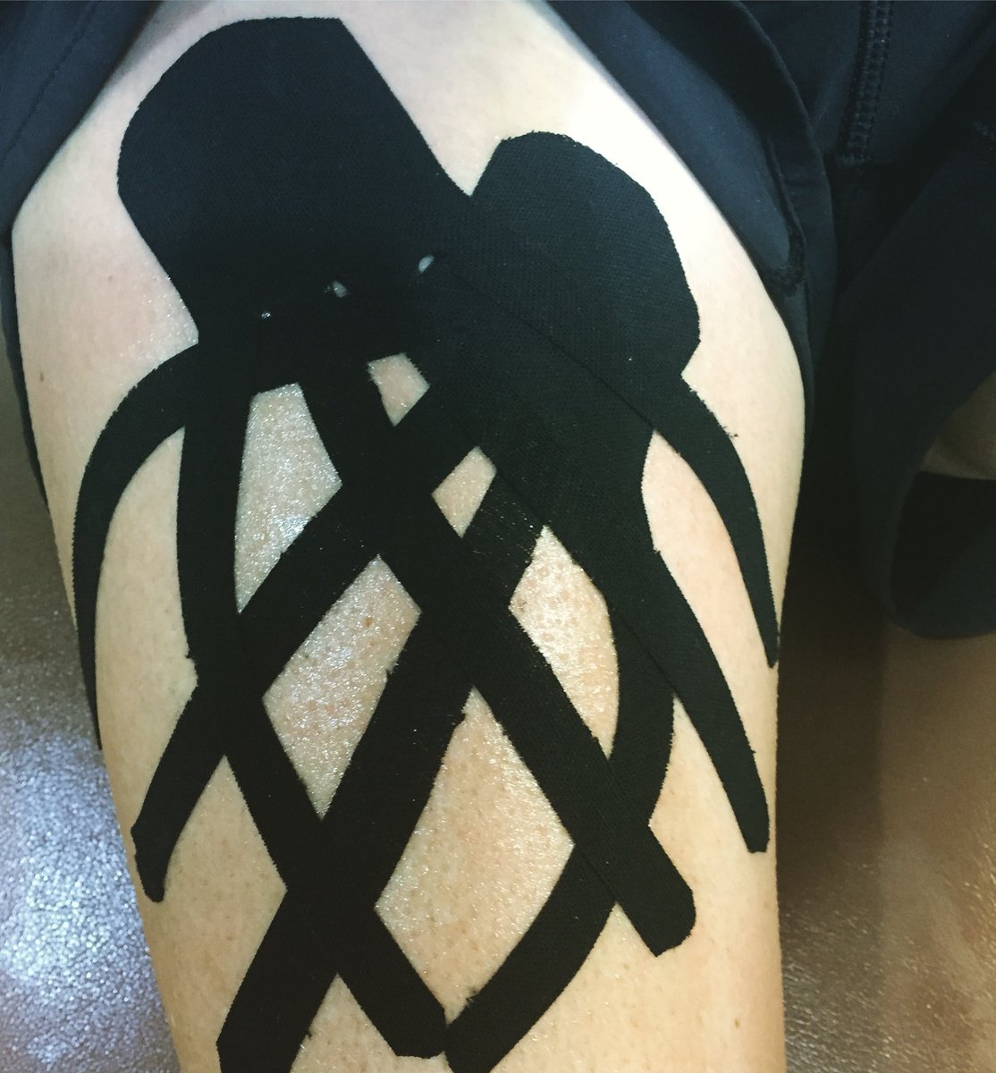 GeorgiaSportsPT's tweet photo. We’re working hard to flush post surgical swelling out of the thigh. Applying kinesiotape in a lymphatic drainage cut can be helpful in achieving this goal. Thx for the photo op Lesley Cortright!!! Proud of your progress so far. #hiplabralrepair #edema #kinesiotape 👏👏👏👏 https://t.co/MYRIO4n4SL