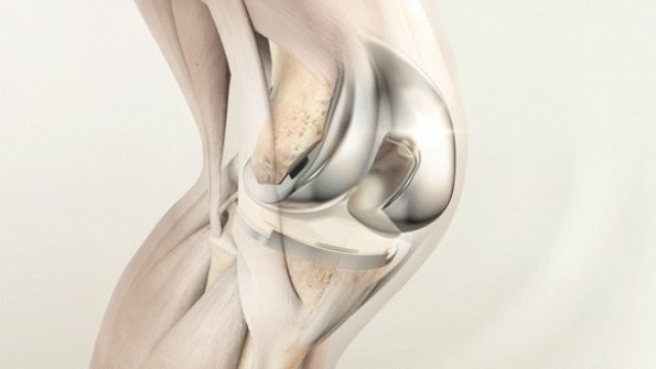 druginjuryatty's tweet photo. Knee Replacement Lawsuit Claims Johnson & Johnson and DePuy Knew of Attune Knee Problems, Yet Continued to Market #DefectiveDevice https://t.co/IV0FSPan0M https://t.co/Ni6PsnaEAl