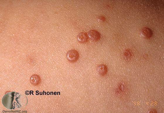 HarkerDavid's tweet photo. Molluscum-like lesions in patient's with AIDS can be caused by:
-Cryptococcus neoformans
-Histoplasma capsulatum
-Penicillium marneffei
#DermPearls
📷: @dermnetnz of actual molluscum for reference. https://t.co/WKO489BIDC