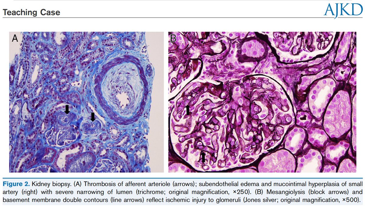 AJKDonline's tweet photo. Teaching Case: #AKI in the postpartum period that illustrates the diagnostic challenges the clinician faces when considering preeclampsia, eclampsia, HELLP syndrome, and TMAs https://t.co/quORwBchwr @PennStHershey https://t.co/6rL1gL2TP4