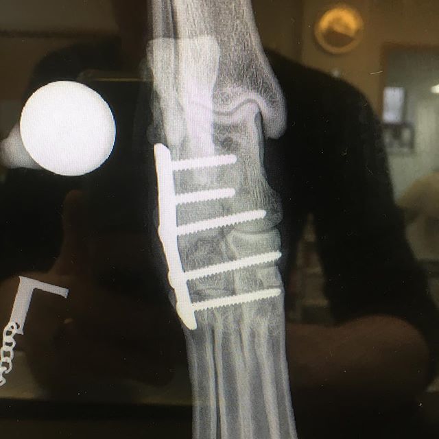 charlyerob's tweet photo. Calcaneoquartal arthrodesis to treat traumatic intertarsal luxation in an 8yo Labrador. A 2.7mm 5-hole DCP has been placed on the lateral aspect of the joint which was packed with corticocancellous freeze dried chips to speed up bony union. 8 weeks rest for this lady and fin… https://t.co/d3kOigWRbN