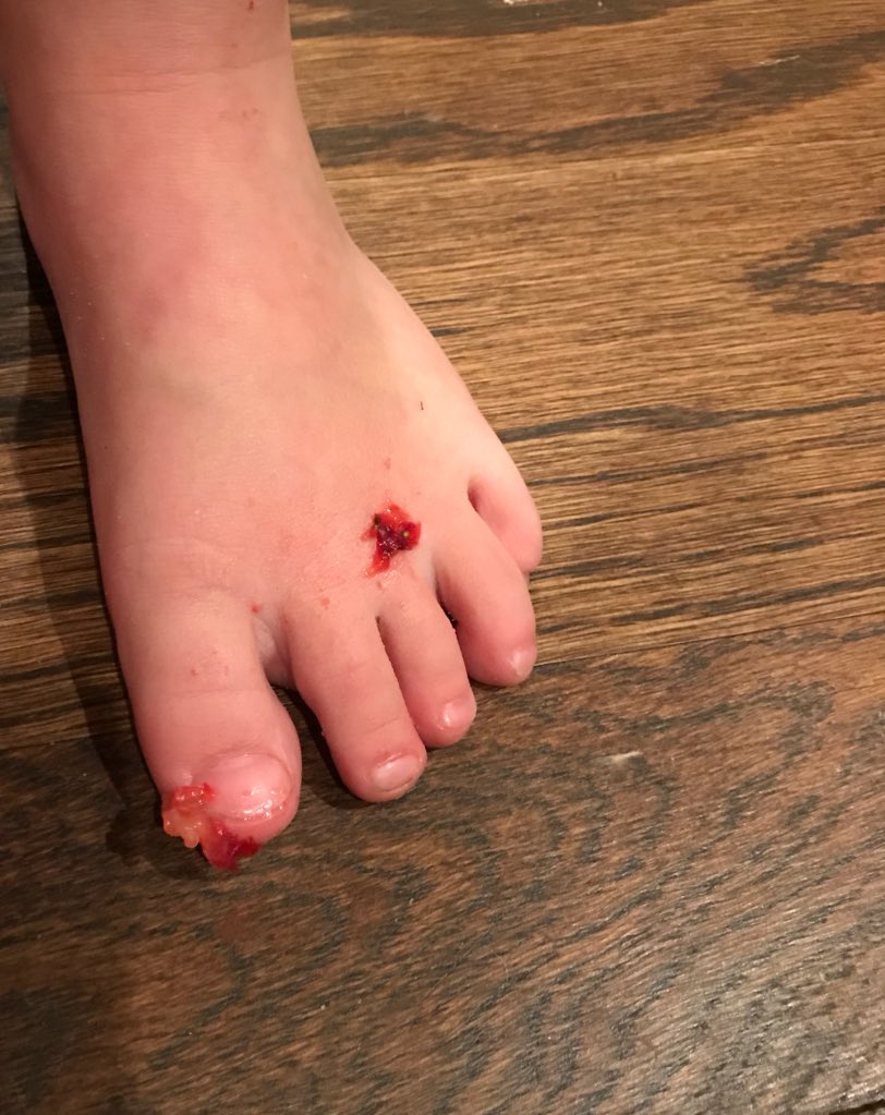 Ellie sounded very upset and asked what happened to her foot as she showed me this. I thought she maimed her toe/made it explode and I was all 😱🤭🤢😱. It turned out she stepped on some strawberry pieces that fell from the baby’s high chair.
