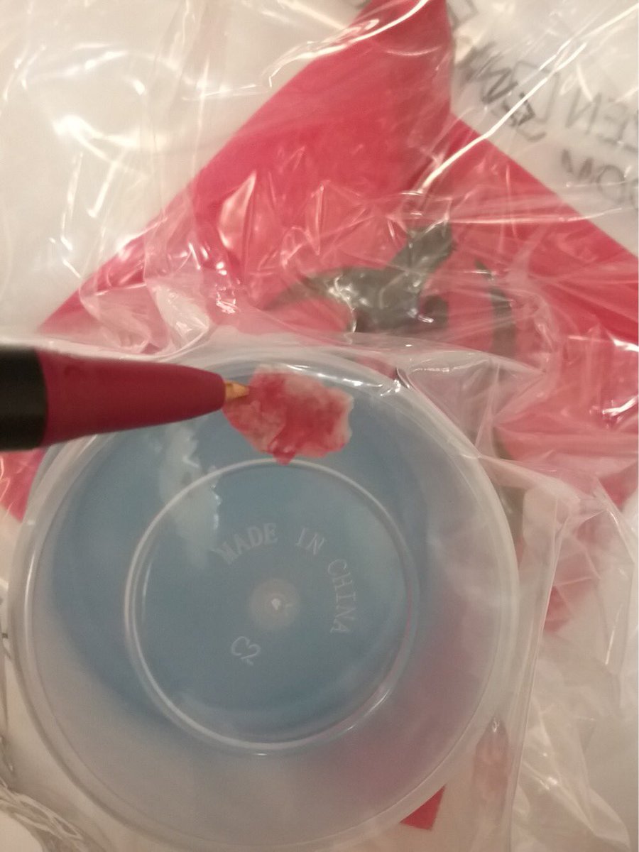 Part 2/2: 25 yo M IVDA with pulmonic valve vegetation.  Successful Angiovac aspiration of 1.1cm vegetation with TEE guidance and no contrast.  Vegetation positive for micrococcus luteus, antibiotics adjusted accordingly. <a href="/Striker9DO/">Joseph DeMarco</a> <a href="/gsiskin/">Gary Siskin</a> <a href="/SIRRFS/">SIR RFS</a> #withoutascalpel #IRad