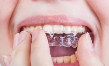 Novologik's tweet photo. The risks of mail-order teeth straightening - Australian Society of Orthodontists https://t.co/F90yJmjCHe https://t.co/b6hLNvZz4G
