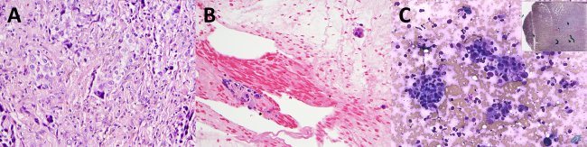 CancerCytopath's tweet photo. Next-generation sequencing of #cytologic preparations: An analysis of quality metrics https://t.co/RpRCrKpkXA https://t.co/hF2lCffzlB