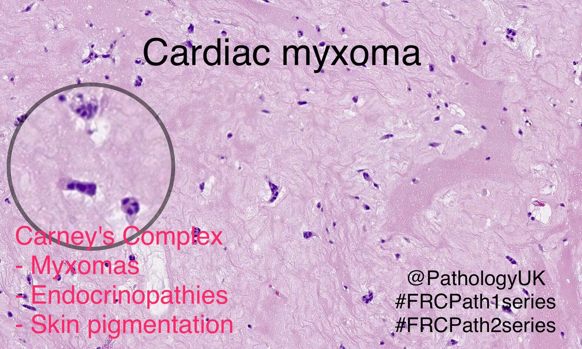 DigitalPathJC's tweet photo. Cardiac myxoma - classical features. 7% cases assoc. with Carney's Complex. More pics below. #FRCPath1series #FRCPath2series #pathology https://t.co/OHRlzPqnQM