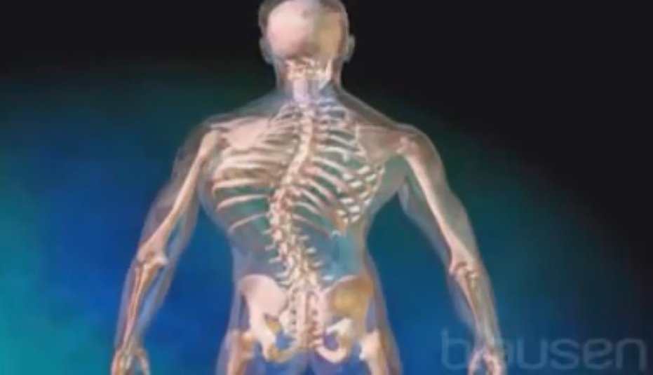 Compartimos este vídeo sobre la escoliosis vía Fisio 2.0 facebook.com/Fisio2.0/video…