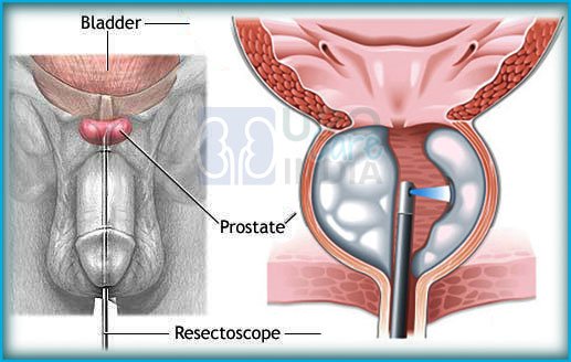 Prostatitis hasi hasi Területi gyengeség a prosztata kezeléssel