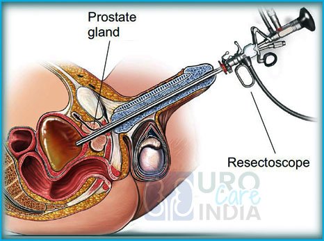 Urocareindia On Twitter Transurethral Resection Of The Prostate