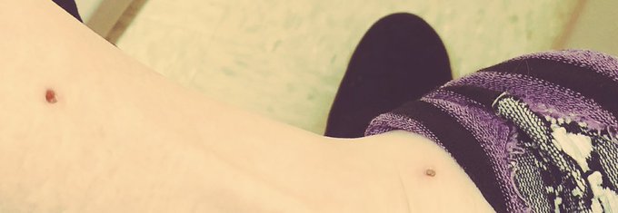 On a bright note. My #SkinBiopsies are healing up nicely. As soon as they are healed, I have TWO #FootFetish<a href="/tag/skinbiopsies"class="tags">#SkinBiopsies</a><a href="/tag/footfetish"class="tags"><span>#footfetish</span></a>