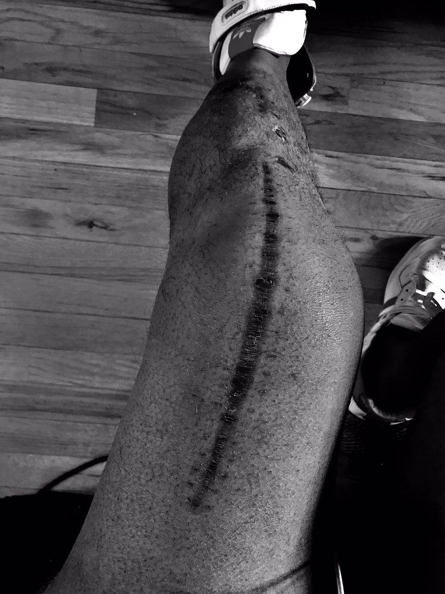 corycondrey's tweet photo. —THE BATTLE SCARS! 
The devil will try to get in your head saying, "Don't show your scars,
It looks ugly." ..but I think different, 
your scars and mine are beautiful!

Show your scars! Your scars scream you survived and won the WAR. 
"Give God Glory!" Believe it!  #Winning https://t.co/Cx7gt4kEIn