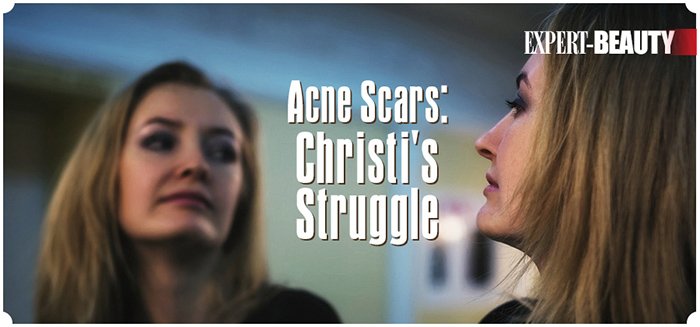 TheSkinyOnSkin's tweet photo. How Christi got her groove back by getting her pre-acne skin back...link-->  https://t.co/zjKCmAJmP1  #acne #acnetreatment #teenacne #adultacne #acneclinic #skin #beauty #skincare #dermatologist #dermatology #toronto #the6ix https://t.co/VDI1bI0Mn2