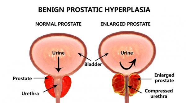tratamientos de la hiperplasia prostatica benigna
