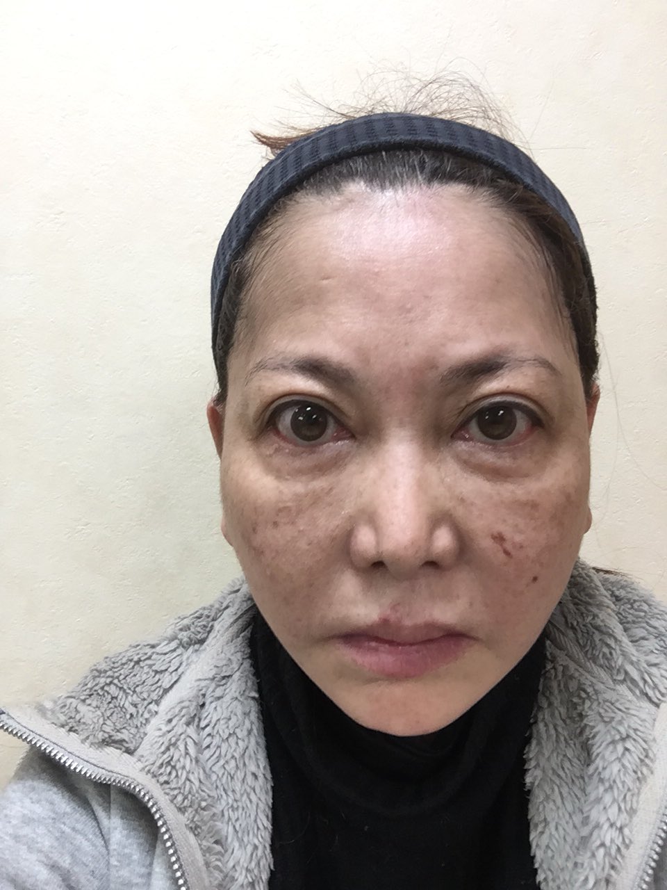 中村うさぎ No Twitter 整形２日目 思ってたほど腫れなかった 以前やった時はもっとパンパンに腫れたから覚悟してたのに ちょっと肩透かしw 今回は切り取った皮膚が少なかったからかな 傷痕は こんな感じ グロいね 赤黒い部分は内出血です