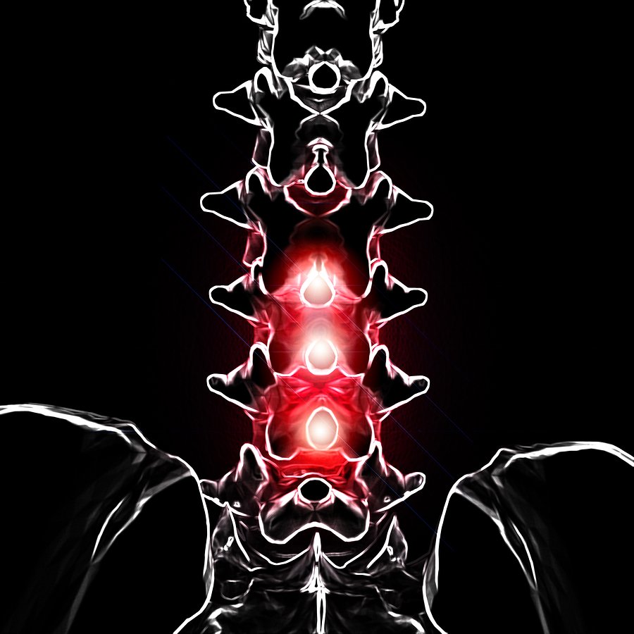 clevelandunivkc's tweet photo. An analysis of a national survey recently published in the journal, SPINE, reports a substantial proportion of U.S. adults utilized chiropractic services with positive outcomes. https://t.co/OrMdYNxeJ4 https://t.co/yXwEIDNmKb