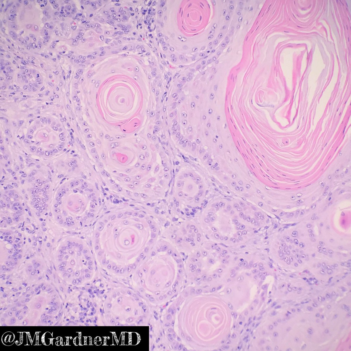 Keratin pearls. Trapped keratin within cystic nests of invasive squamous cell carcinoma. Unlike the horn pseudocysts of a seborrheic keratosis, pearls are 1. dense/parakeratin (not loose flaky keratin) and 2. Located in dermis (not epidermis) #dermpath #Pathology #dermatology