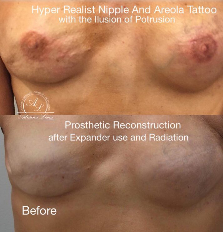 3DNippleTattoo's tweet photo. Nipple &amp; Areola Tattoo is the breast reconstruction last step! It requires no recovery time. https://t.co/sCJWbK3FnN