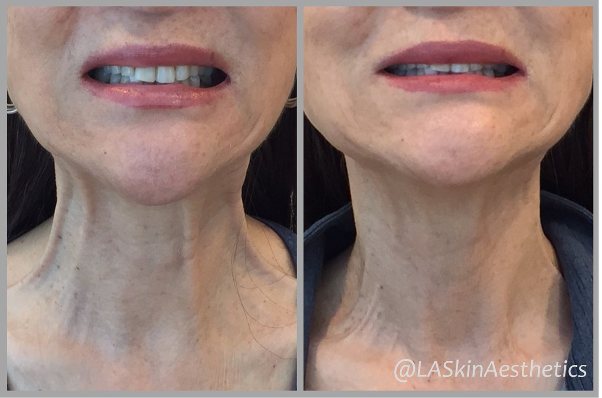 LASkinAesthetic's tweet photo. Platysmal bands are neck muscles that stretch and become more prominent with age.  This causes the skin around the neck to sag and create a ropey appearance.  Placing #Botox in each protruding band helps smooth out the neck and tighten the skin. #laskinaesthetics #beforeandafter https://t.co/4hccrdQHIq