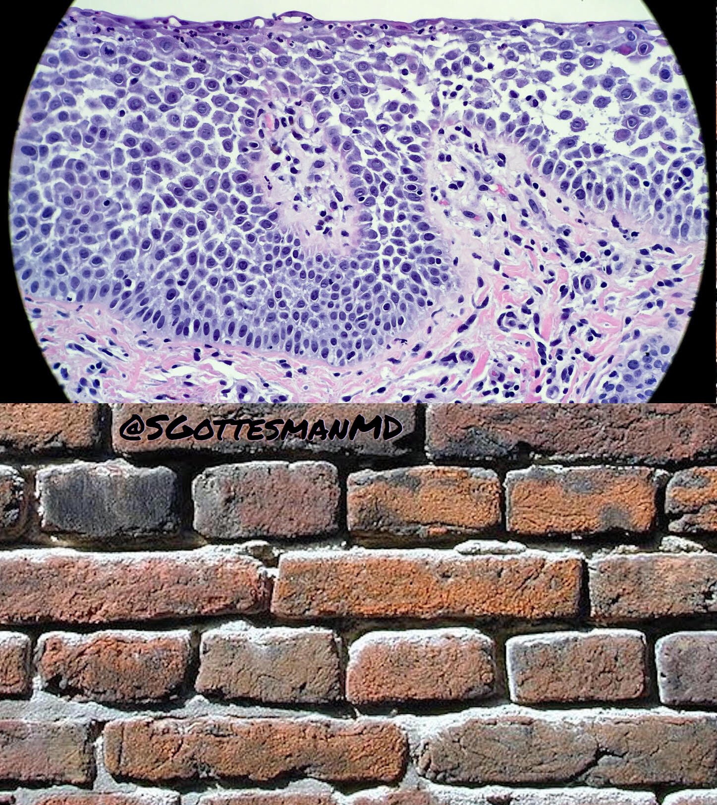 Silvija Gottesman MD on Twitter "Axillary biopsy. Macerated plaques