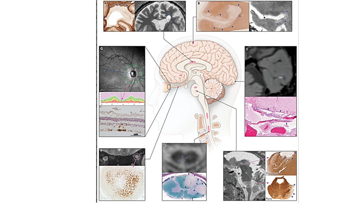 daperezm's tweet photo. Hoy en NEJM revisión sobre "Esclerosis Múltiple", actualización altamente recomendable! 
#EM #Neurologia #in
https://t.co/KlHQ42fnF9 https://t.co/m0ENopllyJ