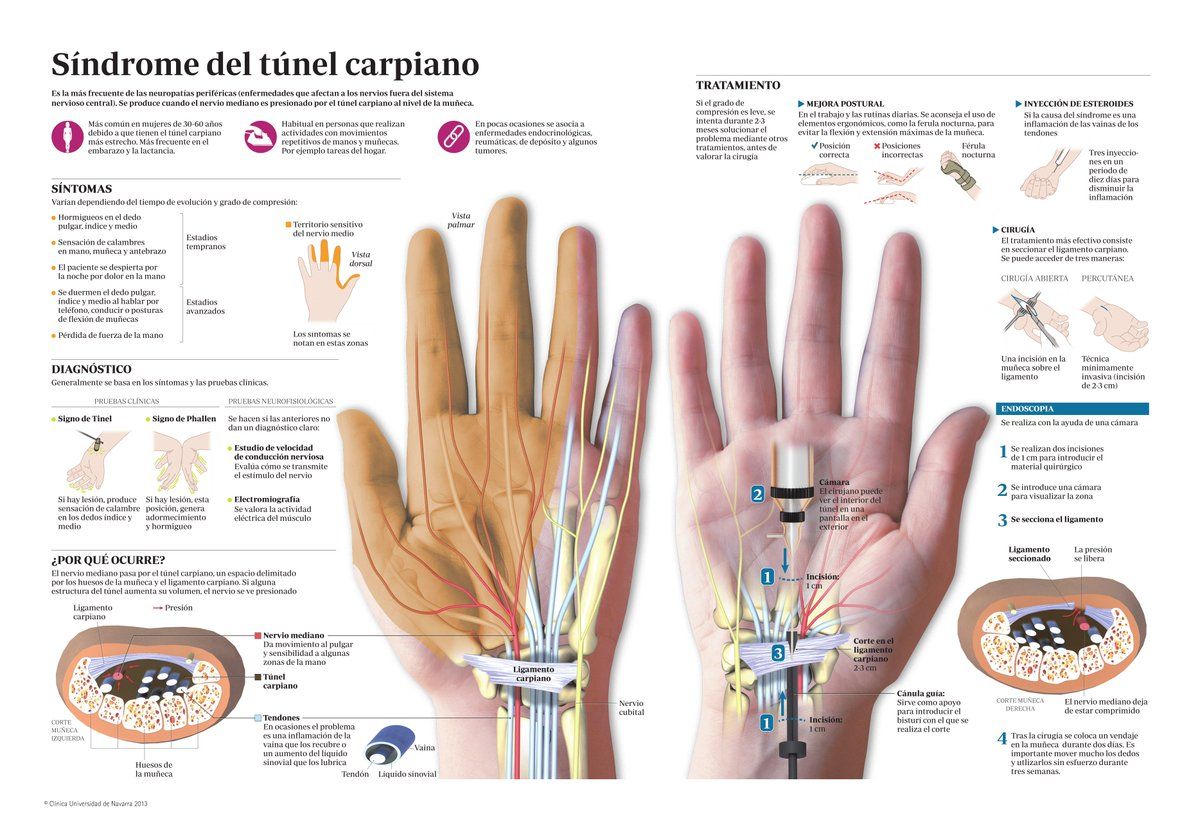 Clinica Universidad De Navarra Ø¯Ø± ØªÙˆÛŒÛŒØªØ± Sindrome Del Tunel Carpiano Sintomas Y Tratamiento Cirugia Muneca Https T Co B6mjamulzc